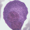 Patologisk plasmacell med två kärnor