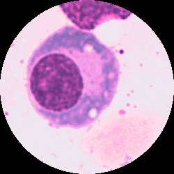 Plasmacell med två typiska "skotthål"
