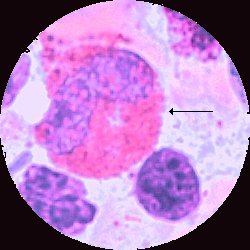 Eosinofil metamyelocyt