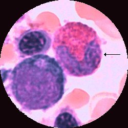 Eosinofil stavkärnig granulocyt