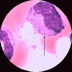 Neutrofil metamyelocyt