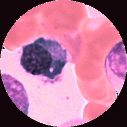 Plasmoblasten är den blåaktiga cellen till vänster om bildens centrum